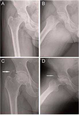 Emerging roles of growth factors in osteonecrosis of the femoral head